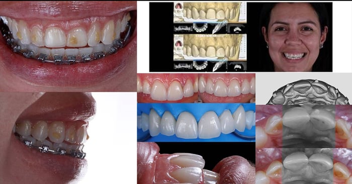 Limites e Possibilidades no uso de alinhadores prévios a reabilitação oral