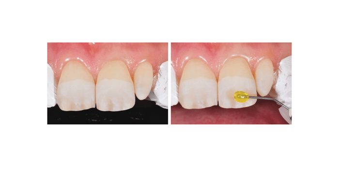 Optimize your bonding procedures in daily clinic - trouble-free & fast