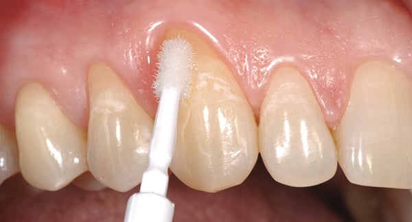 La prévention & le minimalement invasif