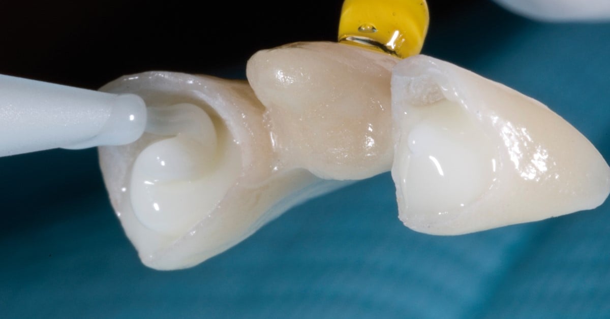 Professional cementation made easy