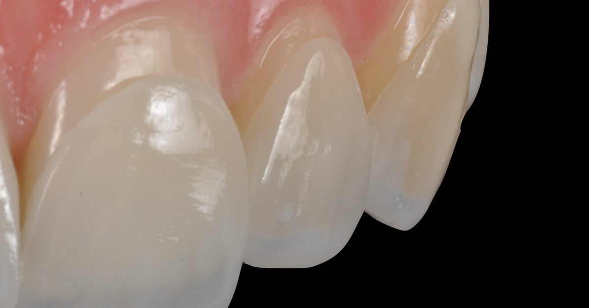 Vertiprep and CAD approach in veneer restorations