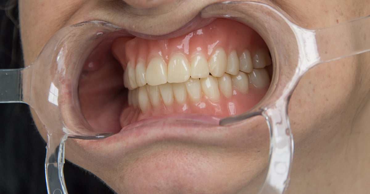Customizing the white and pink esthetics of dentures