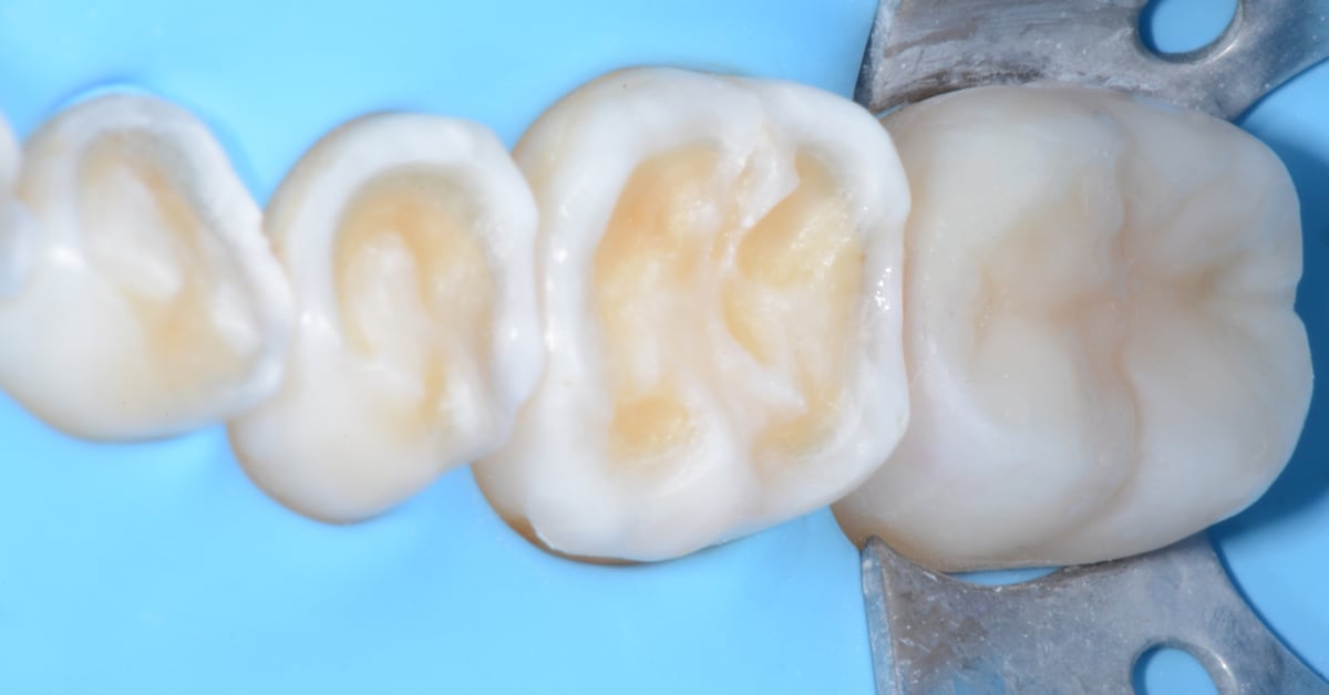 Worn Dentition? Direct and indirect adhesive management through a non invasive approach