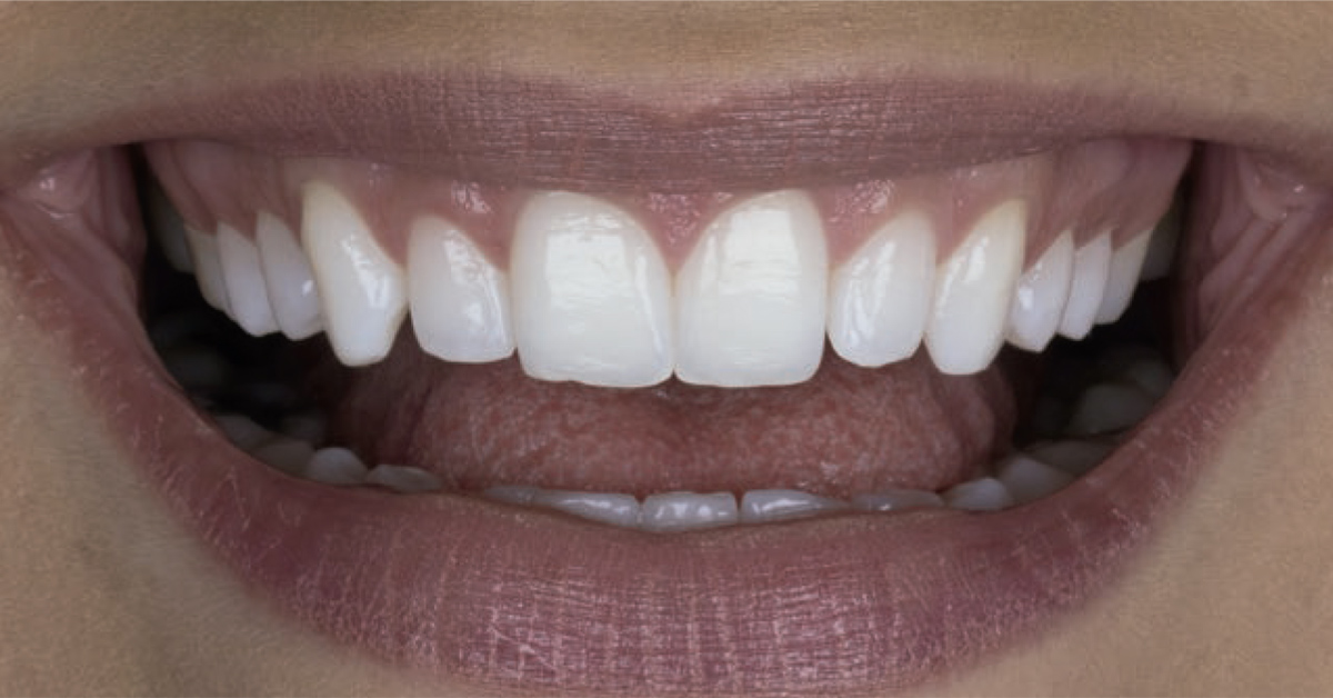 Moderne Methoden der Zahnaufhellung – sicher und effektiv