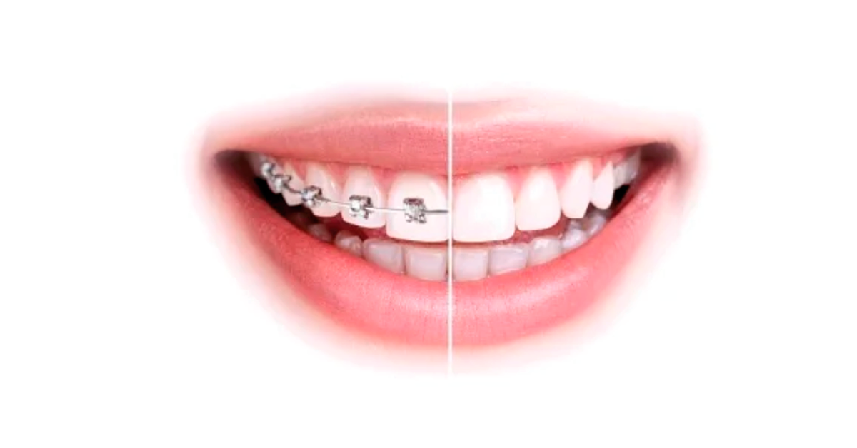 Adhesión en tratamientos de ortodoncia