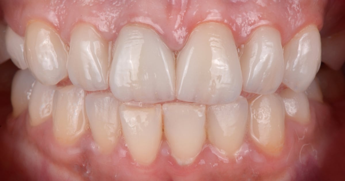 The Management of Discoloured Teeth with Composite Resin