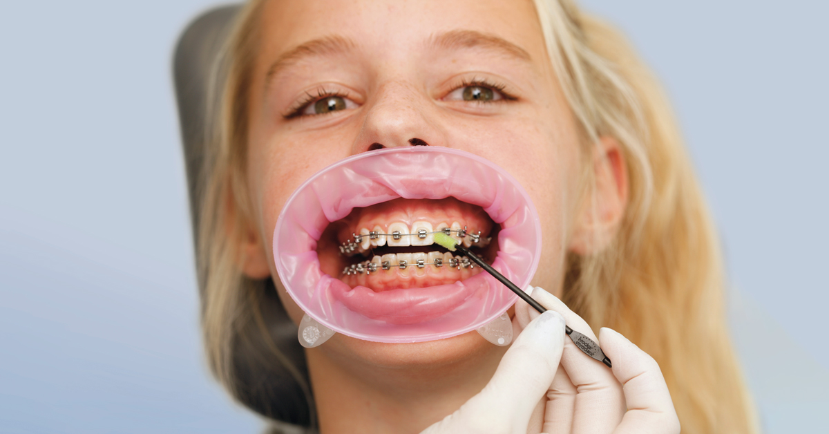 Índices estéticos en Odontología