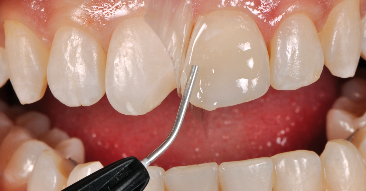 The Art of Efficiency in Anterior and Posterior Restorations