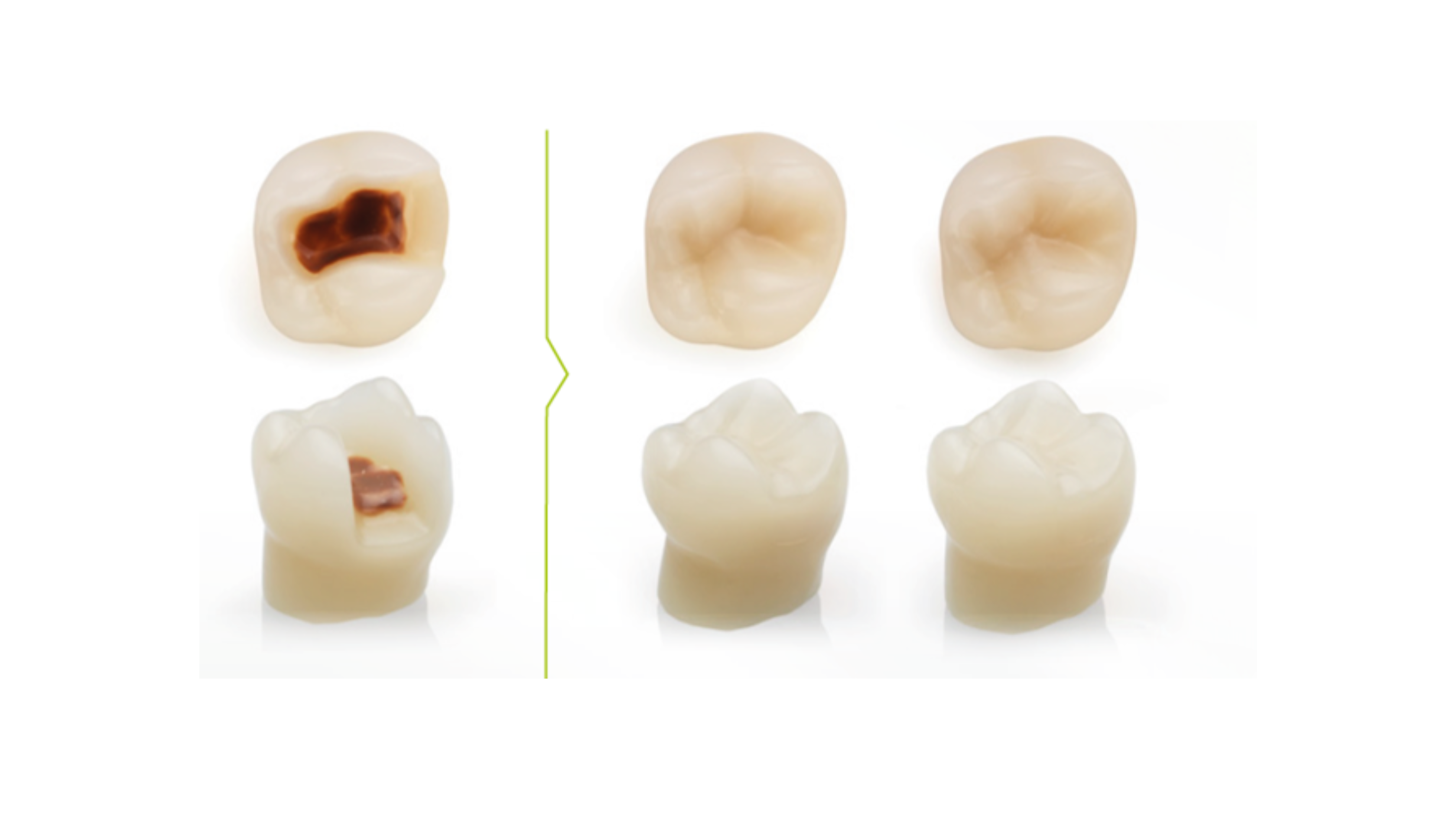 Restorative & prosthetic options for tooth discoloration management